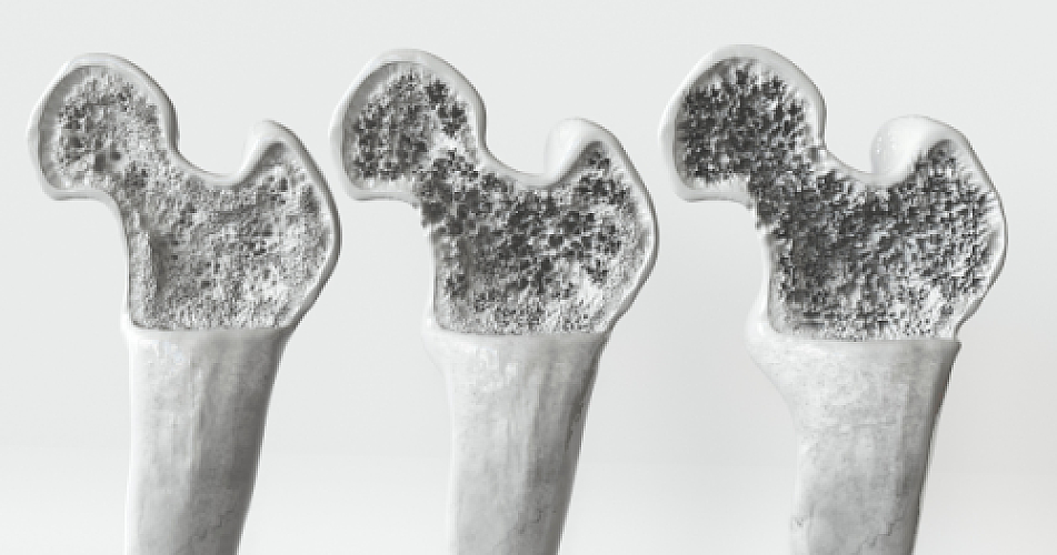 The Great Bone Scandal: How Millions Are Being Misdiagnosed and Mistreated
