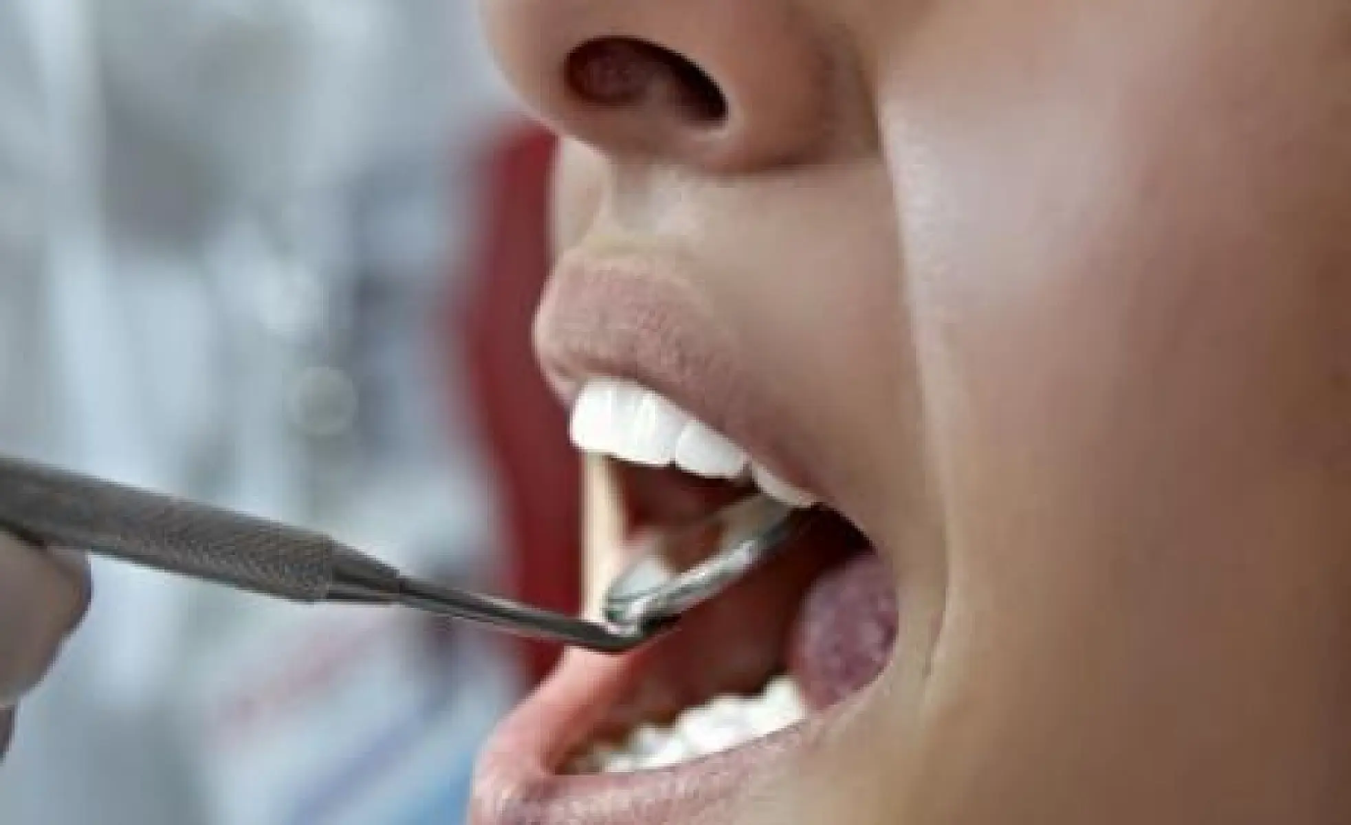 Xylitol in the News: Reading Beyond the Headlines