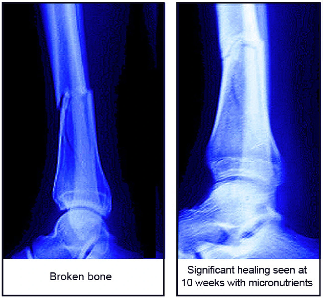 Healing Bone Fractures: Rarely Considered Micronutrients