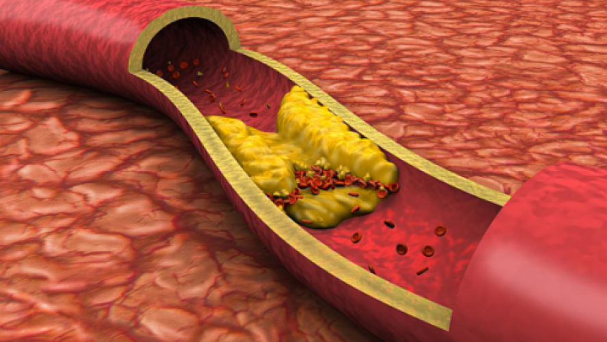 Can You Actually Reverse Arterial Plaque? A Closer Look at the Study Behind the Headlines