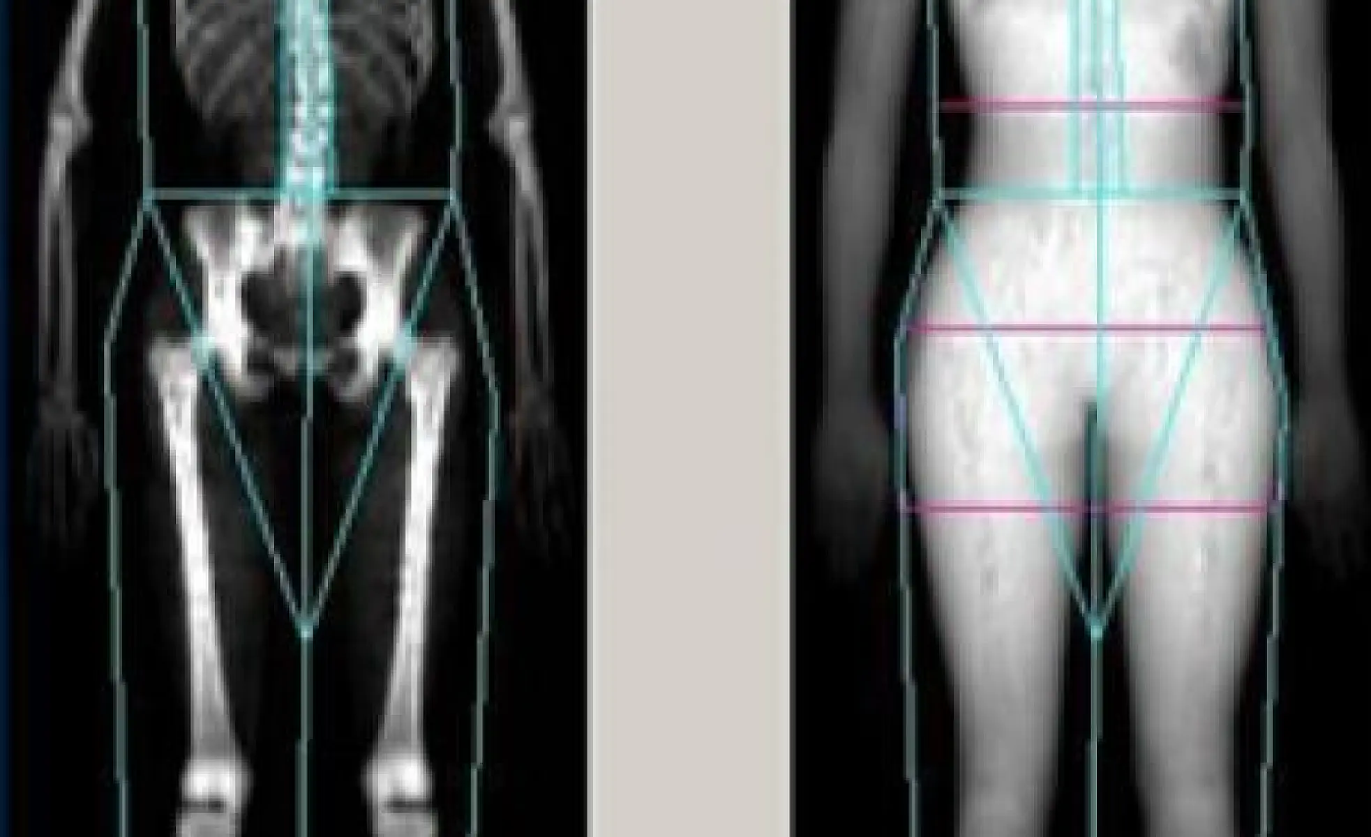 Confirmed: The Lower Your Bone Density, The Lower Your Breast Cancer Risk