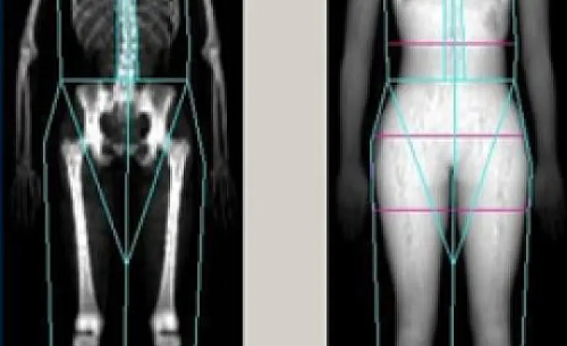 Confirmed: The Lower Your Bone Density, The Lower Your Breast Cancer Risk