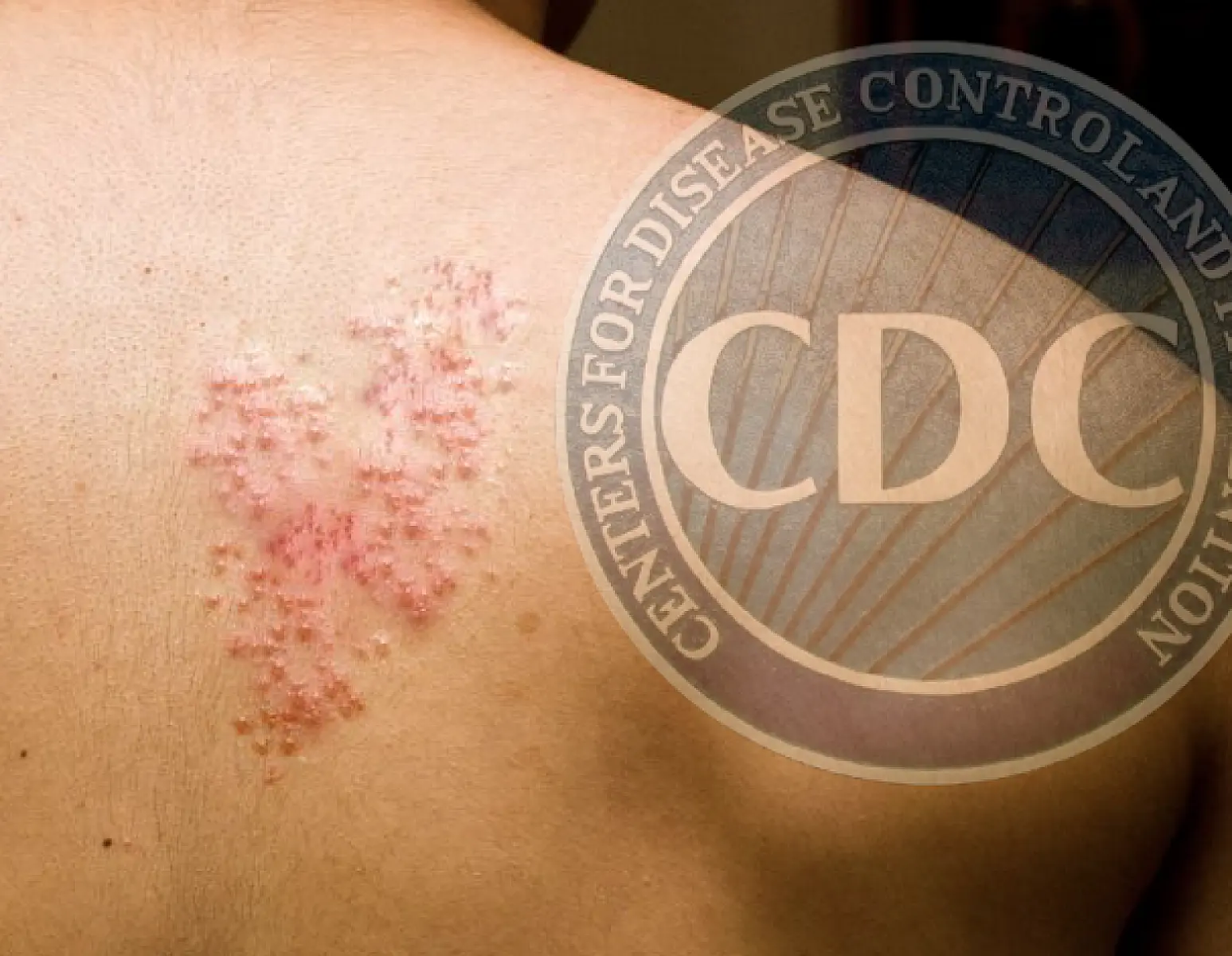 A Pox on the CDC’s Vaccination Agenda: The Rise of Herpes Zoster (Shingles)