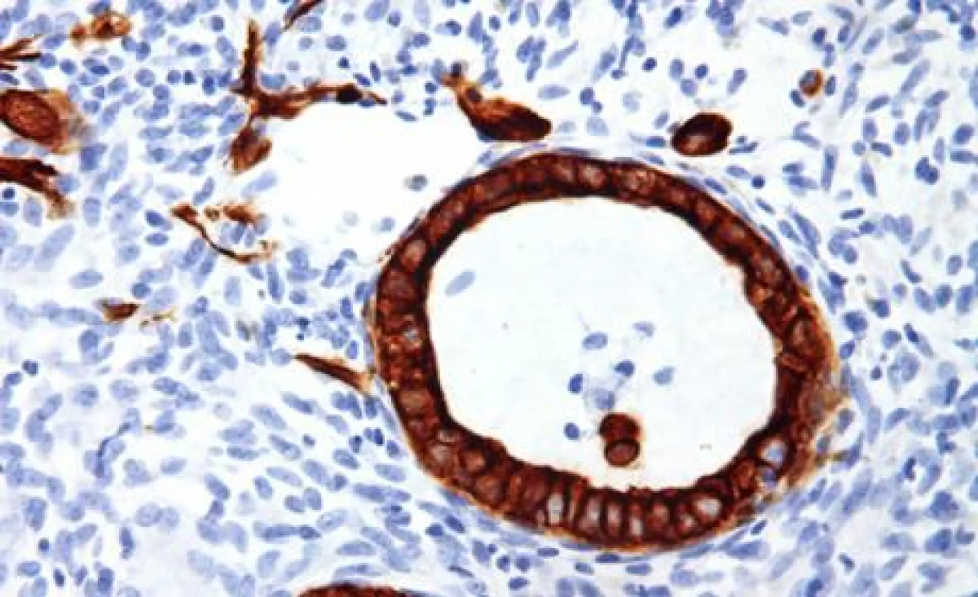 Nicholas Gonzalez, MD, and the Trophoblastic Theory of Cancer