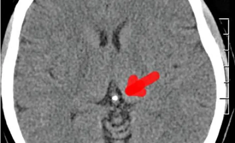 Fluoride Literally Turns the Pineal Gland to Stone, Research Suggests