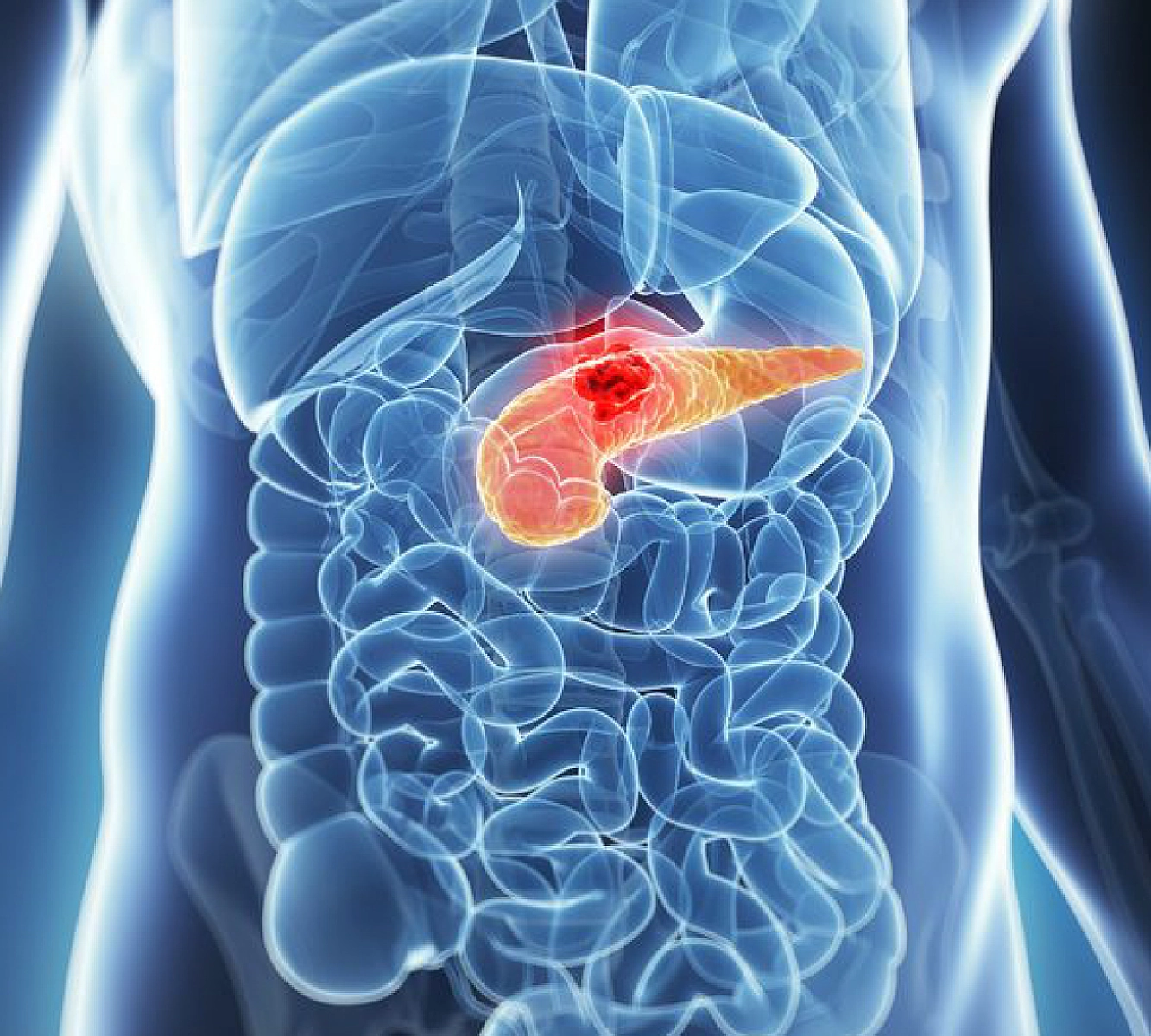 Turmeric Extract Kills Highly Lethal Pancreatic Tumors, Preclinical Study Reveals