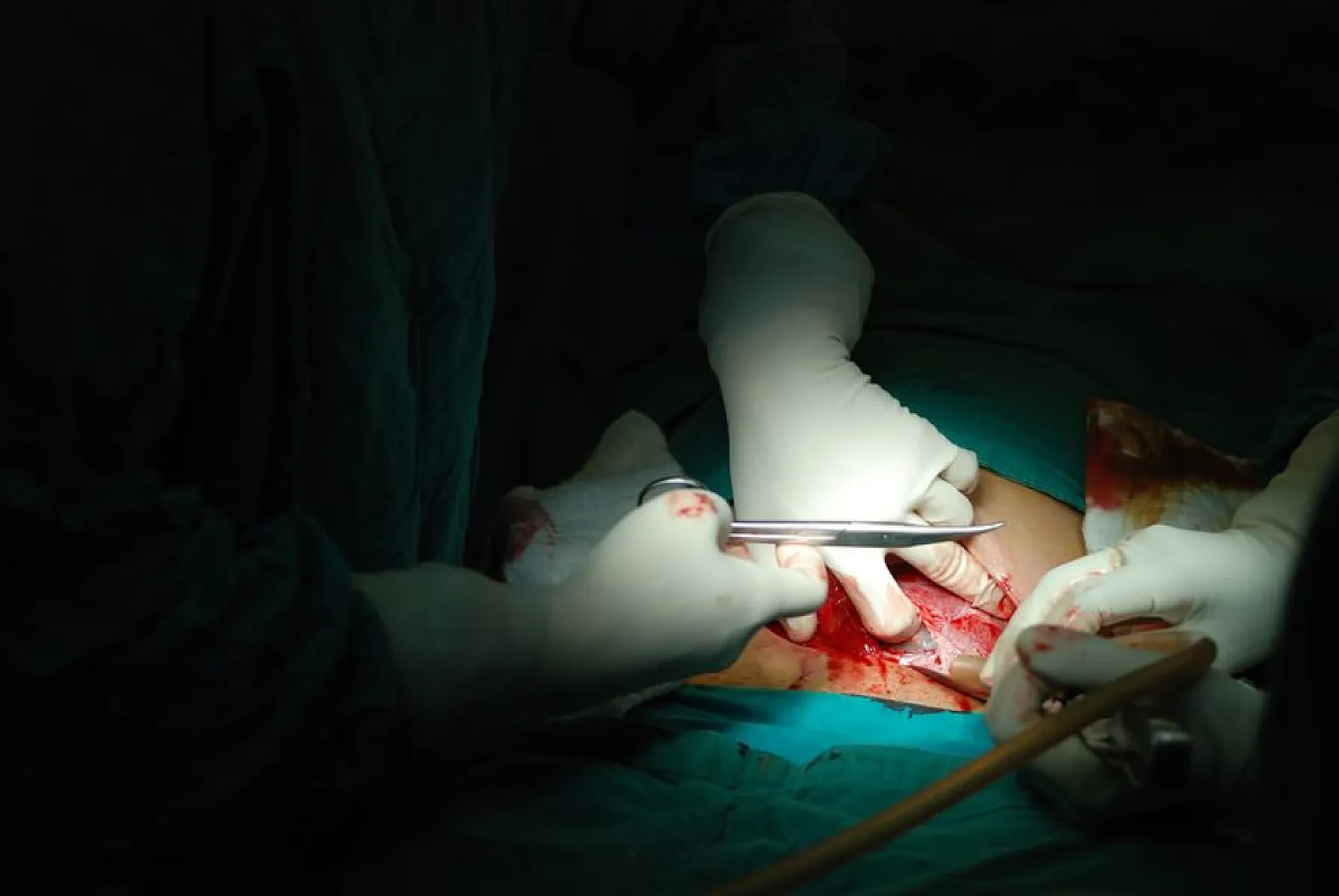 Am Journal of ObGYN's Anti-Homebirth Campaign Sacrifices Lives of 100 US Women Per Year
