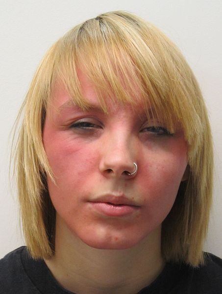 Benzyl Peroxide Burns