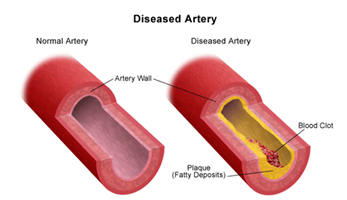 Carotid Artery Stenosis