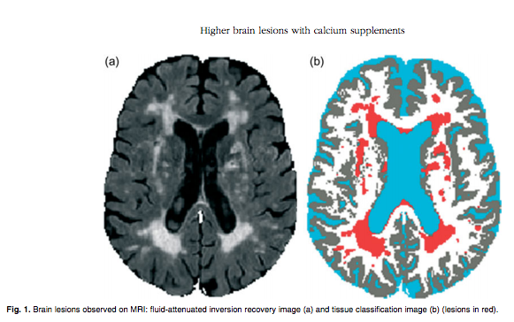 Brain Scan: MRI, Hyperintensities