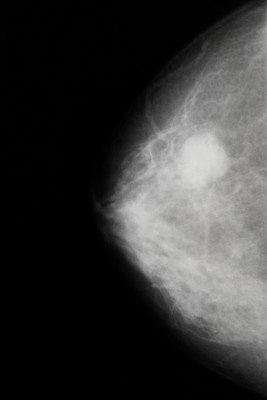 High Bone Mineral Density & Breast Cancer