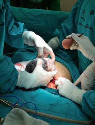 C Section Delivery
