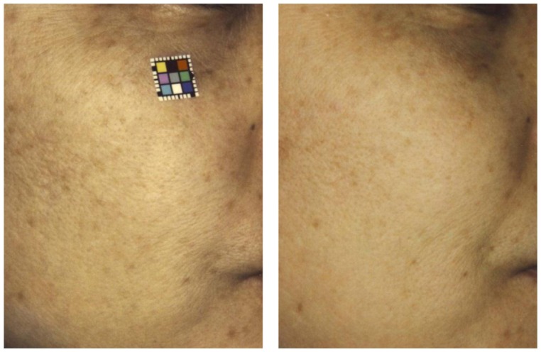 Reversing Skin Aging with Pine Bark