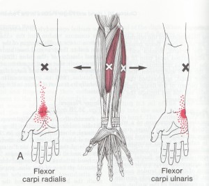 Hand Flexor Trigger Point