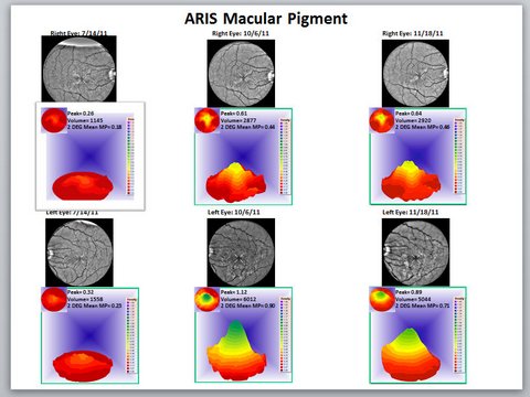 Macular Degeneration