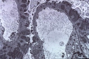 membranous nephropathy