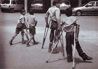 Polio Paralysis India