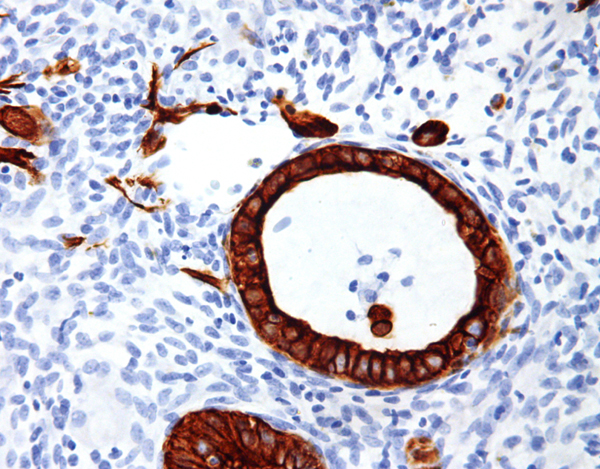 Nicholas Gonzalez, MD, and the Trophoblastic Theory of Cancer