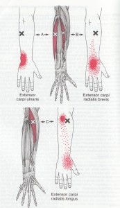 Wrist Extensor Trigger Point